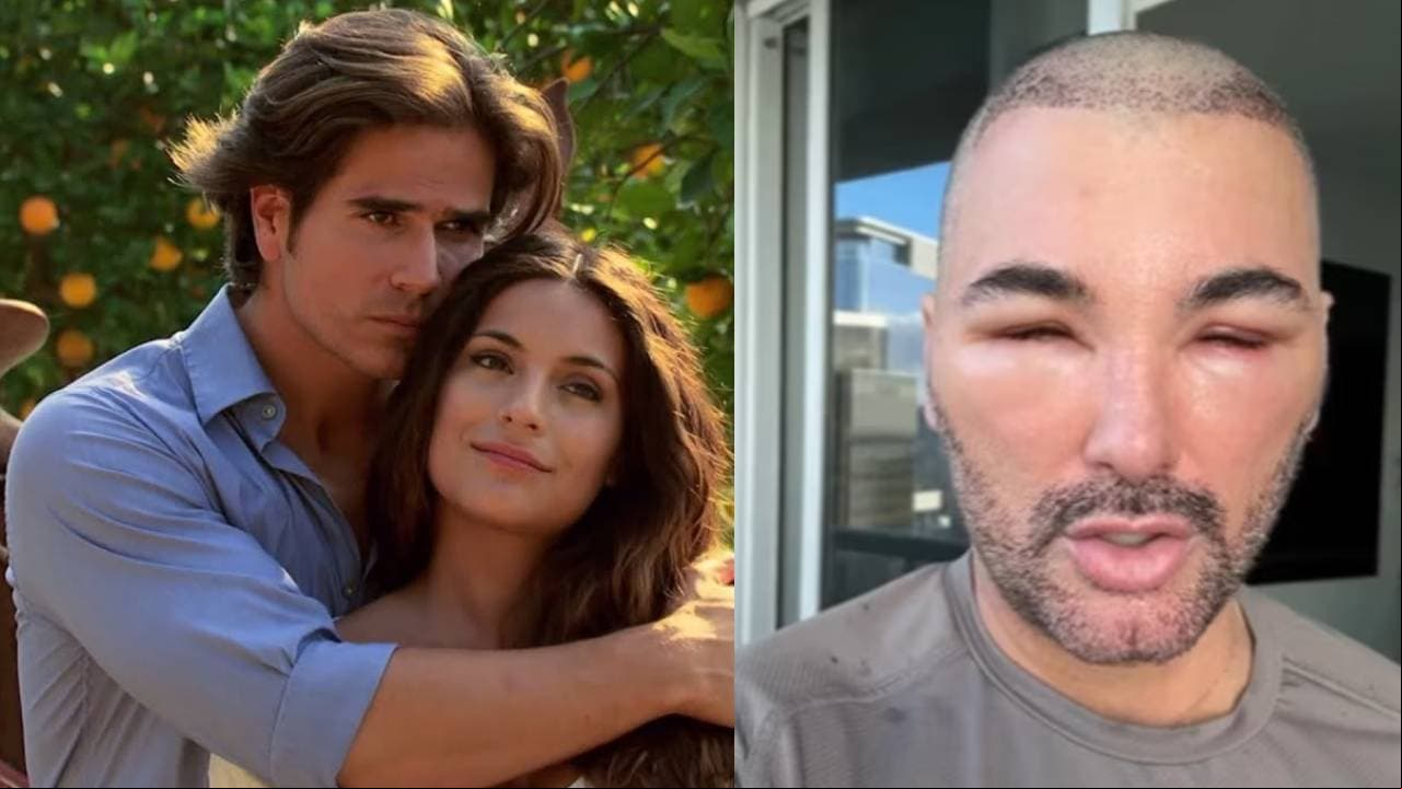 Actor de ‘Corazón Indomable’ aparece con el rostro desfigurado: destapa en video lo que sufrió 