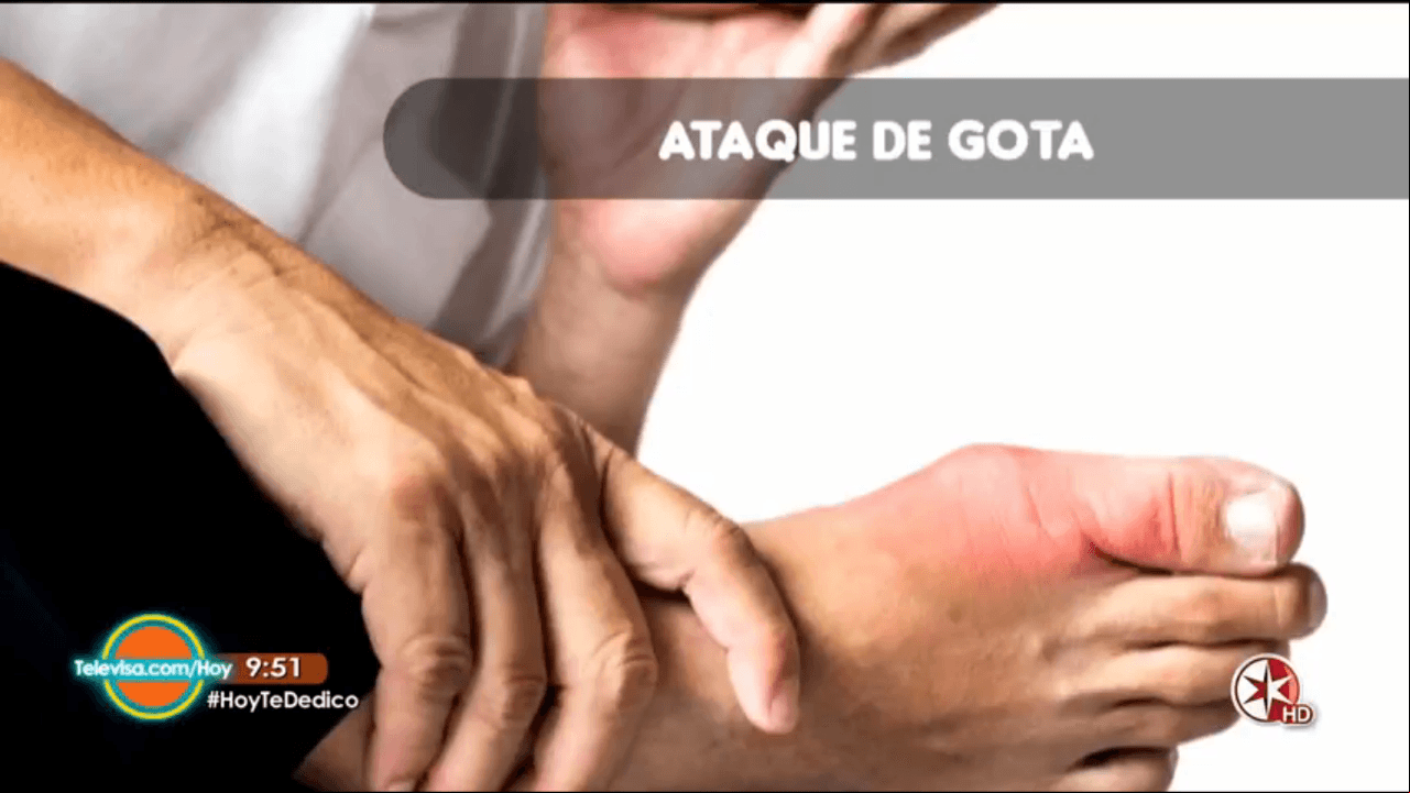 Entérate cómo puedes combatir el ácido úrico