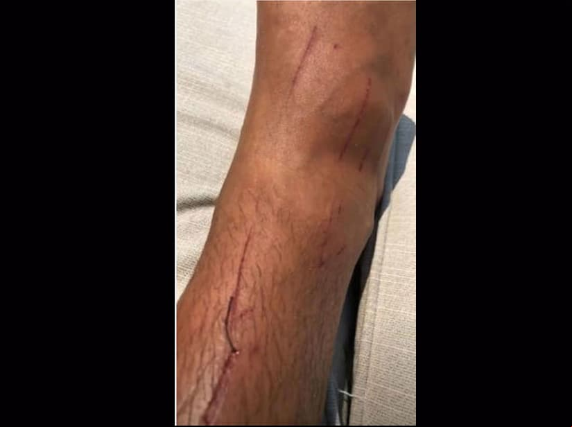Aarón Díaz mostró su herida en redes sociales