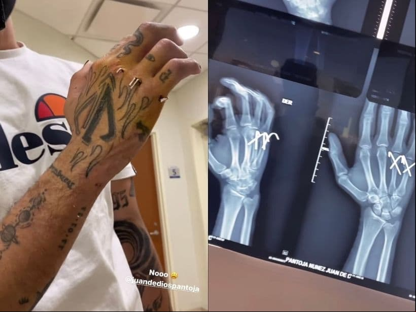 Juan de Dios Pantoja impacta al mostrar los clavos que tiene en su mano.