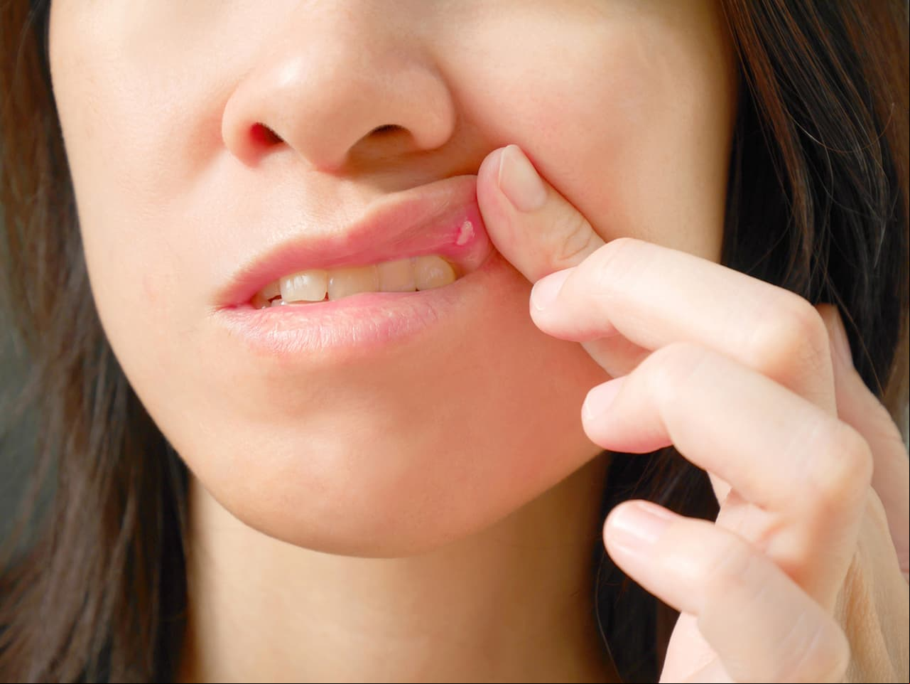 5 síntomas de herpes en las mujeres