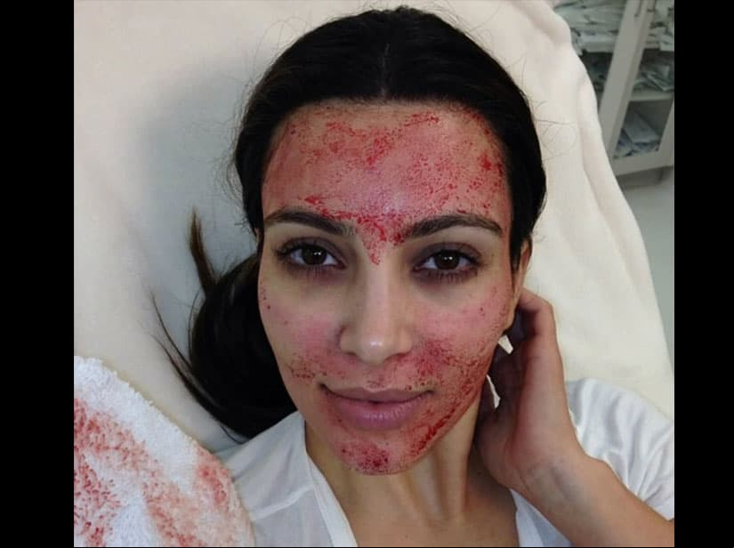 Kim Kardashian se realizó el facial de vampiro en 2013