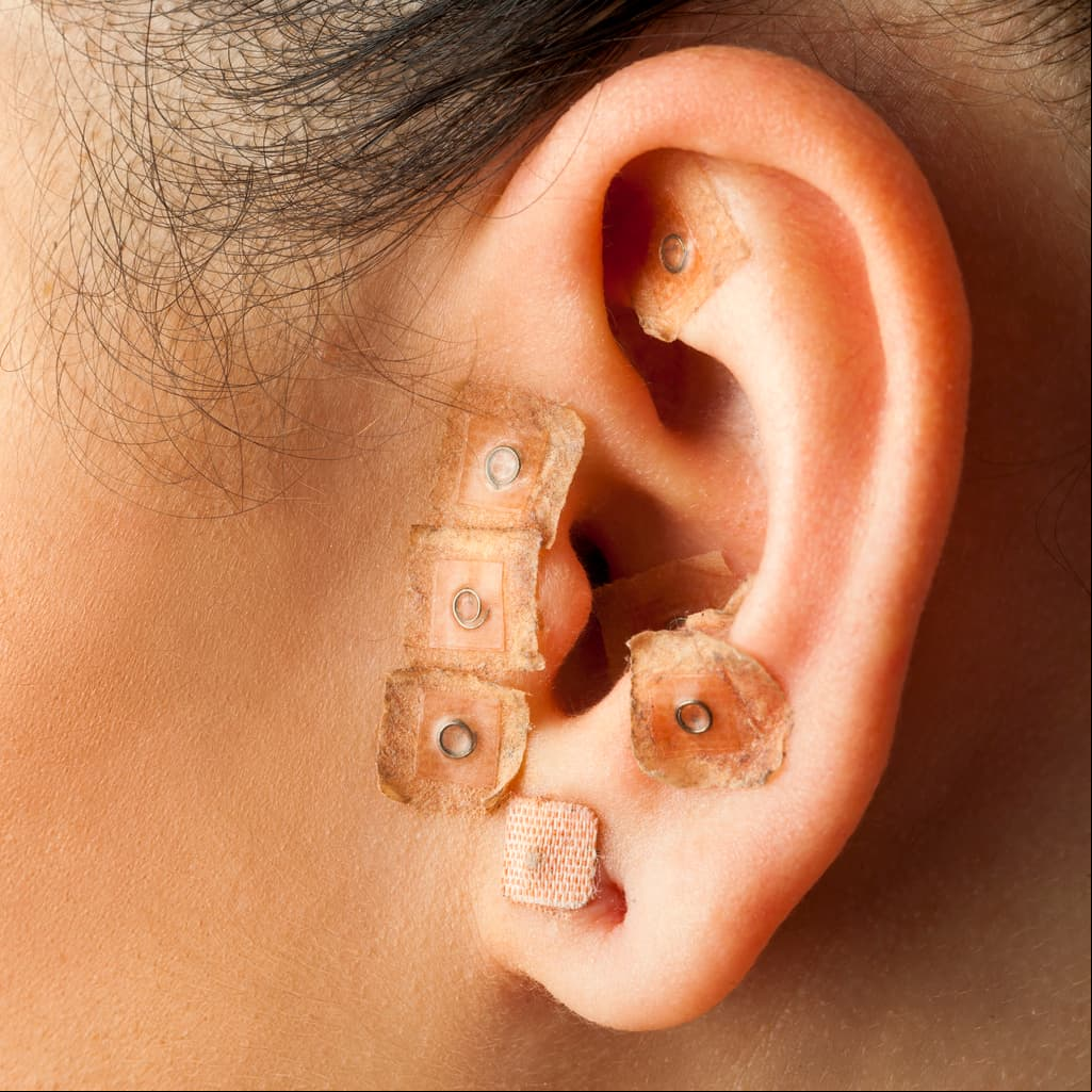 Auriculoterapia para perder peso