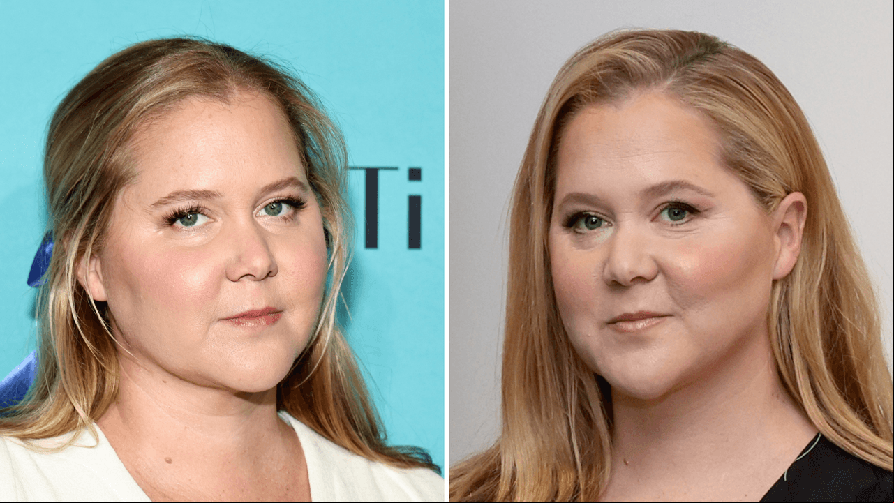 Amy Schumer descubrió que tiene una enfermedad gracias a los 'haters': ¿qué es el Síndrome de Cushing?
